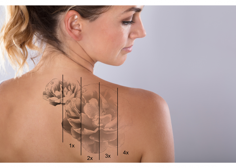 eliminación-tatuajes